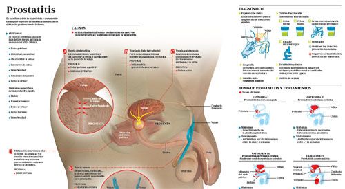 <p>Imagen preview del infogr&aacute;fico sobre la prostatitis</p>