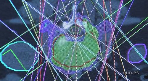 <p>La radioterapia es un tratamiento para los pacientes que padecen c&aacute;ncer. Puede utilizarse como tratamiento primario para curar el c&aacute;ncer, como tratamiento complementario despu&eacute;s de la operaci&oacute;n o como tratamiento paliativo.</p> <p>El gran cambio que ha experimentado la radioterapia es la aparici&oacute;n de la radioterapia de intensidad modulada que a trav&eacute;s de avanzados aceleradores lineales permite precisar la dosis de radioterapia, disminuye la radiaci&oacute;n en los &oacute;rganos sanos circundantes y reduce el n&uacute;mero de sesiones necesarias.</p>