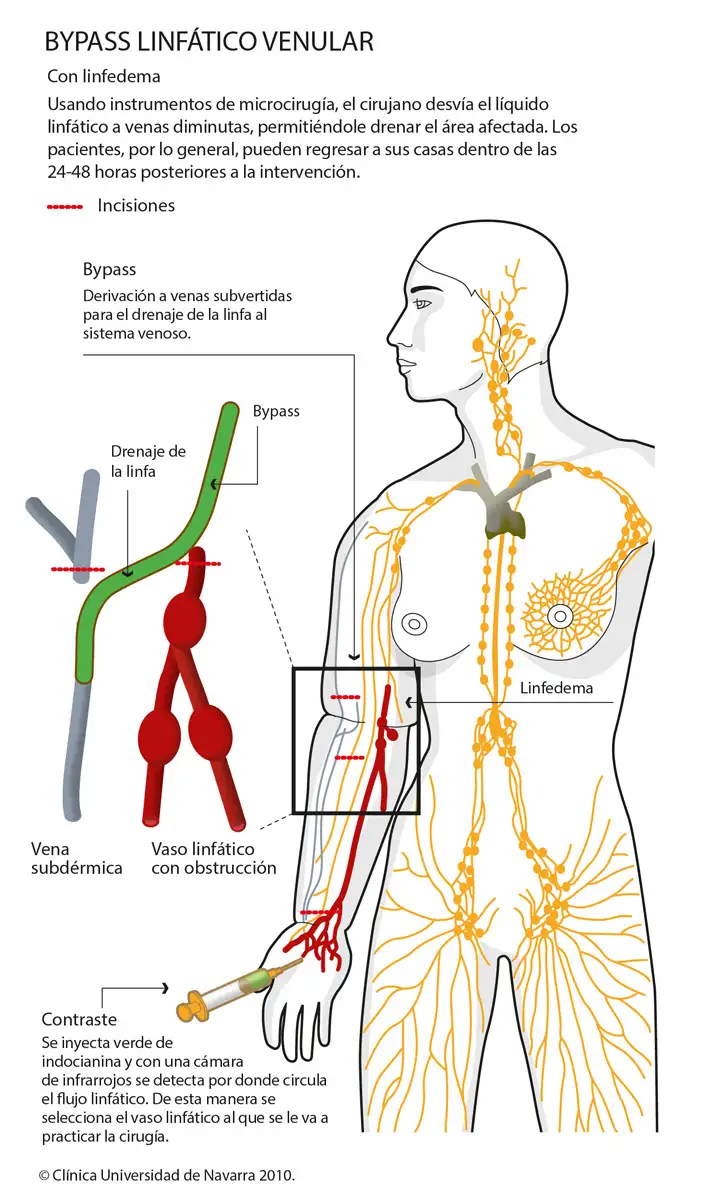 Bypass linfáticovenular para el tratamiento de linfedema