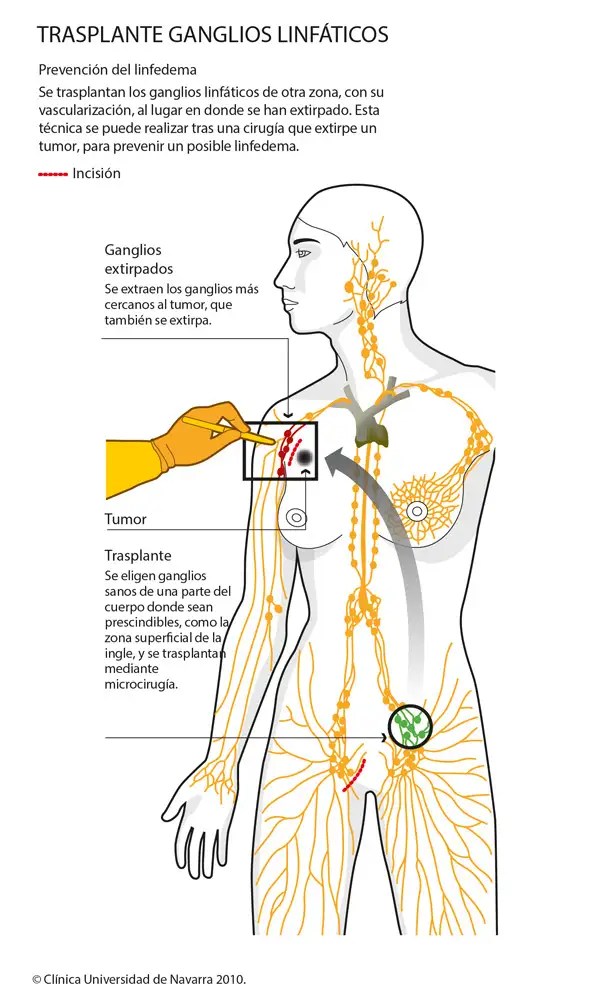 Bypass linfáticovenular para el tratamiento de linfedema