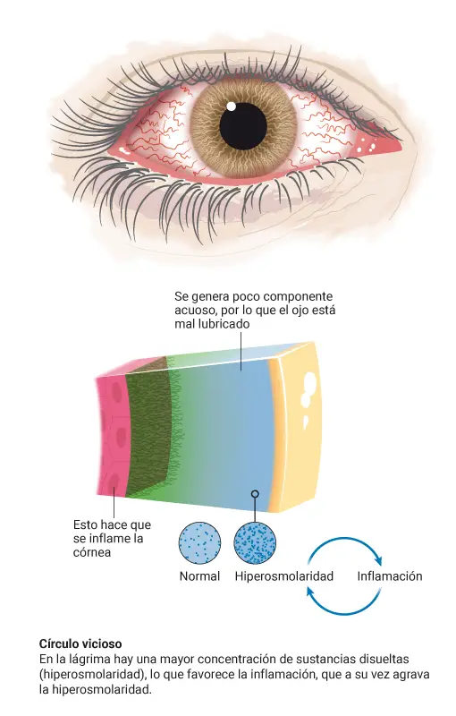 Infografía sobre el tipo de ojo seco acuodeficiente, el que tiene una disminución en la producción de lágrimas acuosas.