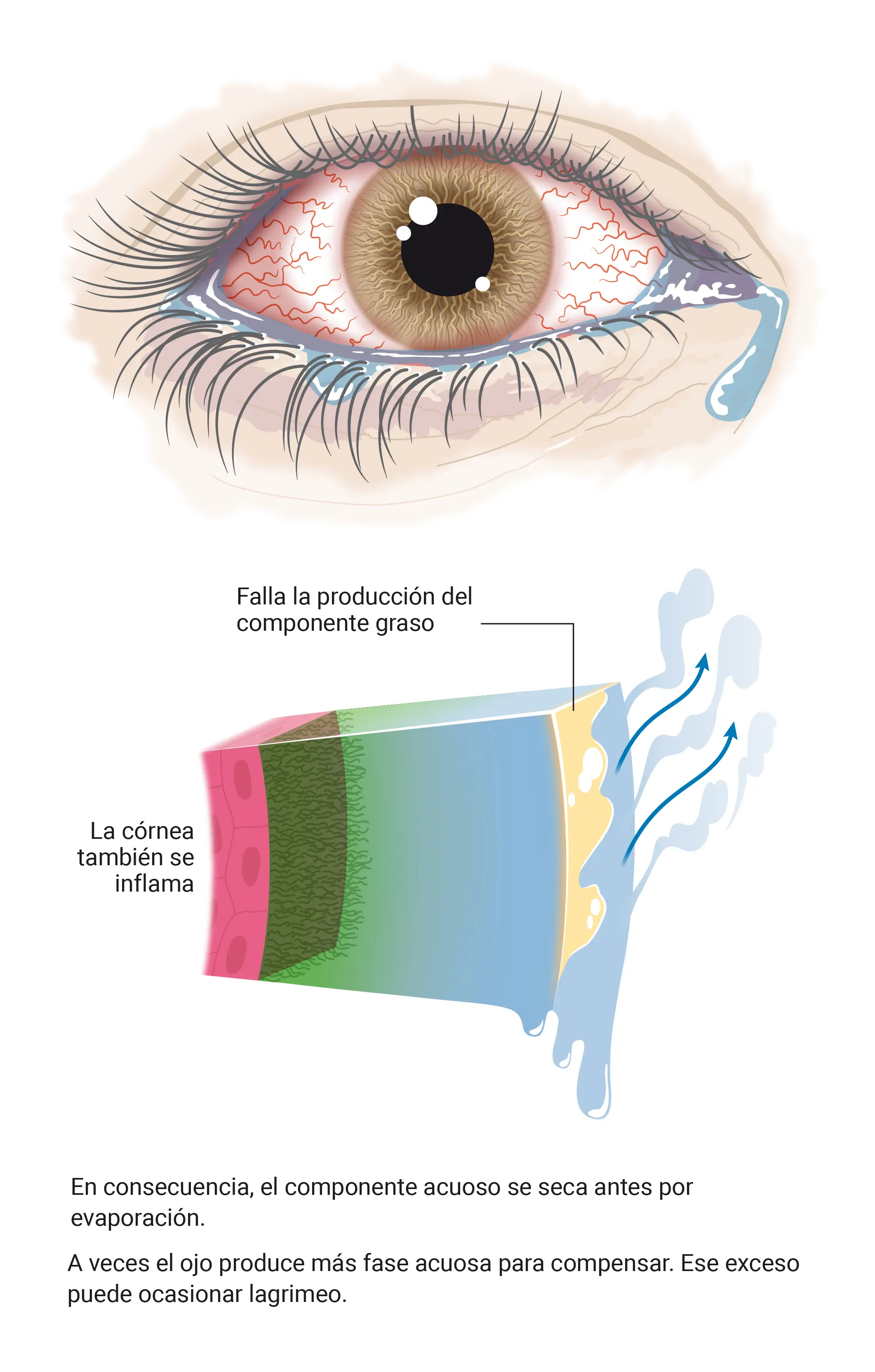 Infografía sobre el tipo de ojo seco evaporativo, una disminución en la producción de la capa lipídica de las lágrimas o por una mayor evaporación de esta capa.